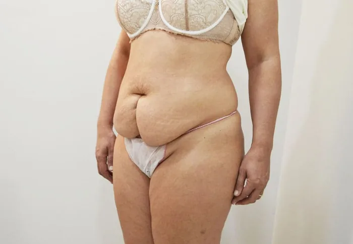 Abdominoplastia (antes) — Clínica Ibiza Madrid