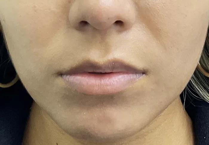 Aumento de labios con ácido hialurónico (antes) — Clínica Ibiza Madrid